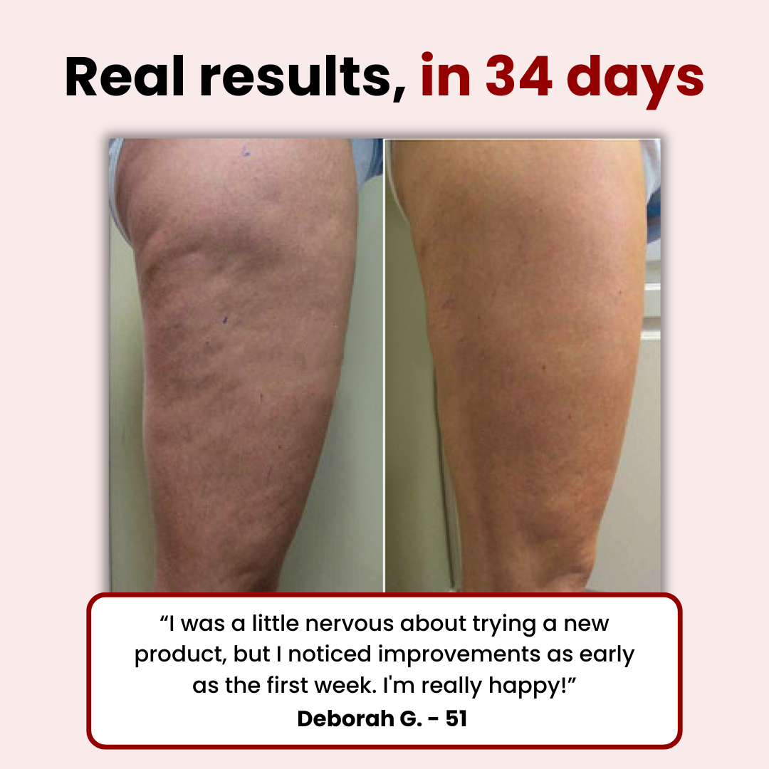 ZeloraLab™ Anti-Cellulite & Fat-Burning Massager